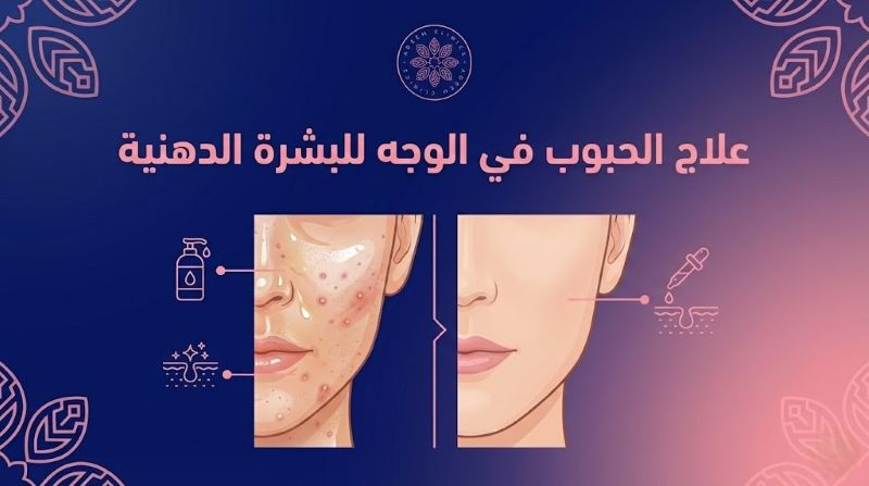 علاج الحبوب في الوجه للبشرة الدهنية: كيف تحصلين على بشرة صافية